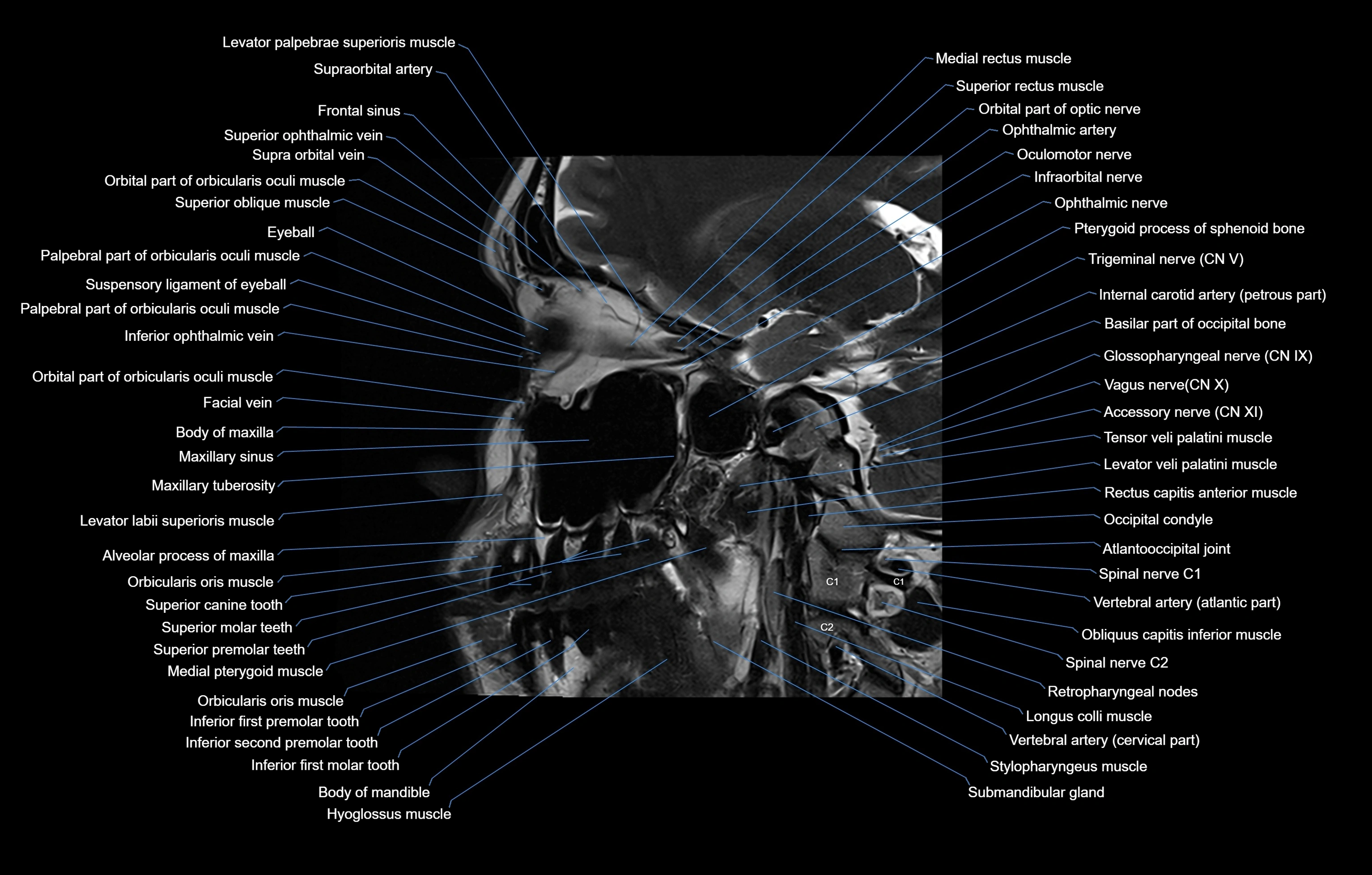 paranasal sinuses(PNS) MRI coronal  cross sectional anatomy 3T radiology  image-img-00001-00009.webp